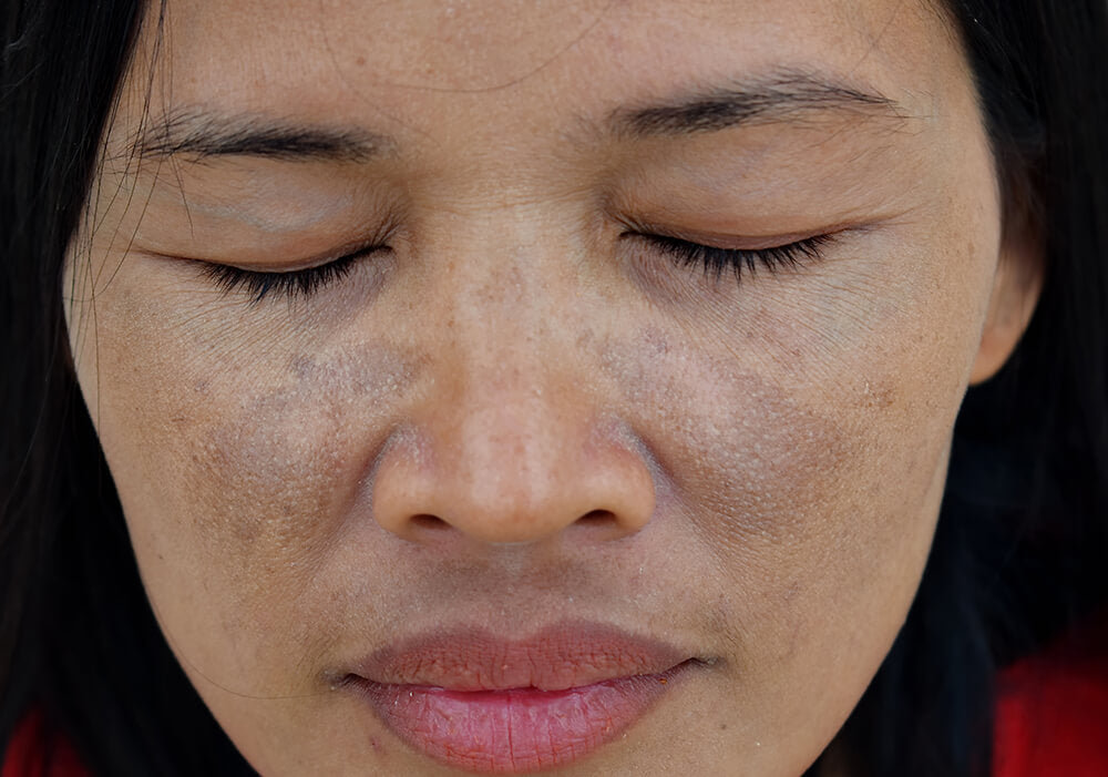 Melasma hyperpigmentation on a woman's cheeks