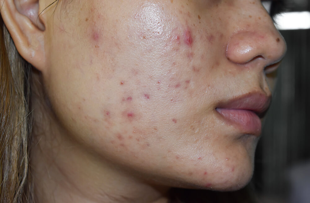 A woman with post-inflammatory erythema from acne lesions