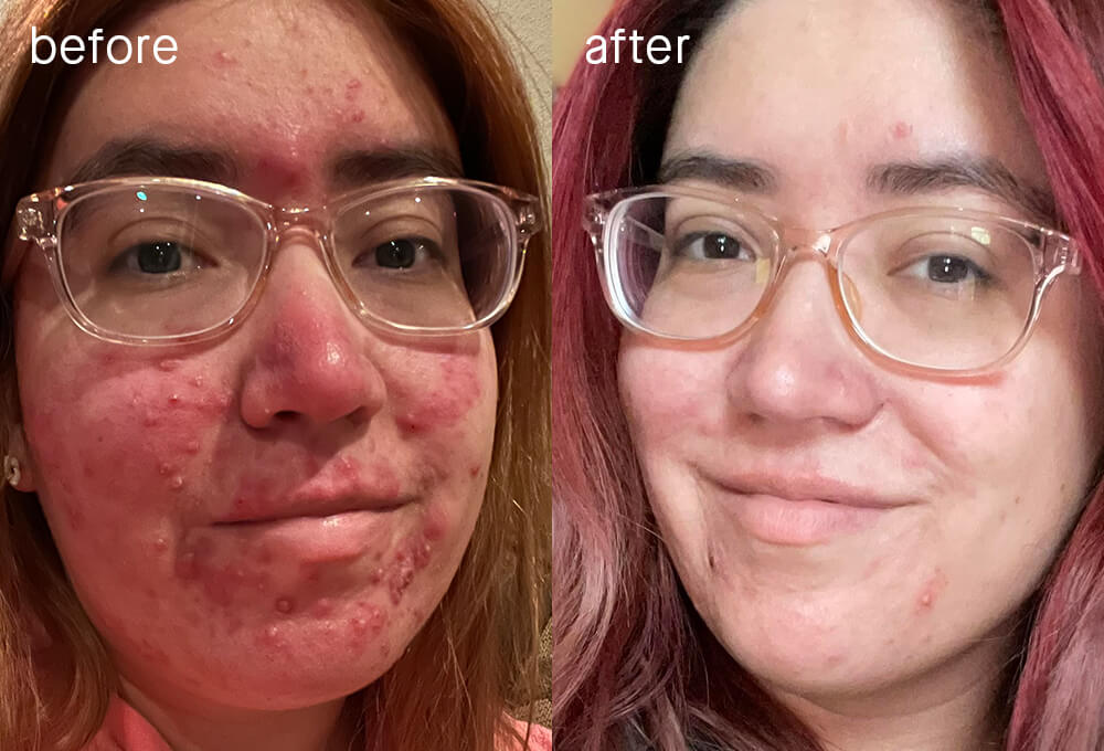 Before and after image of SLMD Acne System user Susana showing acne clearing up