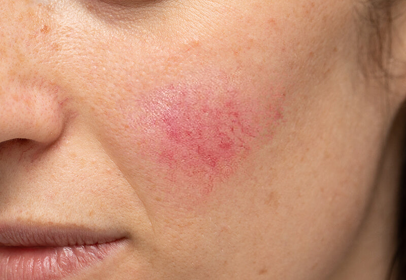 A woman with visible blood vessels aka telangiectasia from rosacea