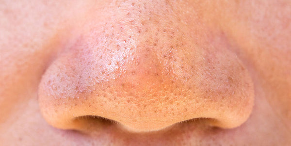 A closeup photo of sebaceous filaments on a man's nose