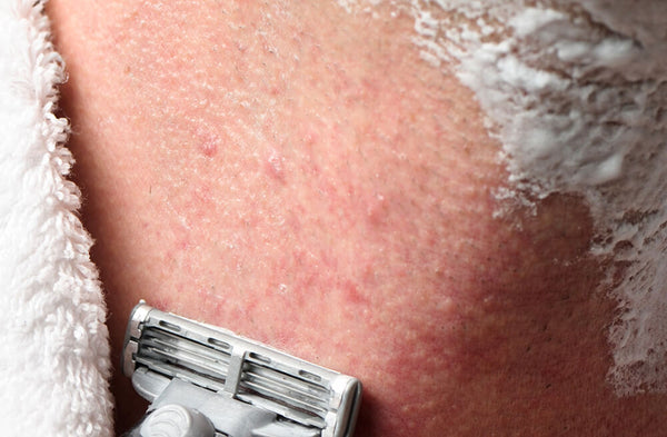 Razor burn that can sometimes look like acne