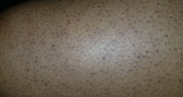 Keratosis pilaris that can be treated with glycolic acid