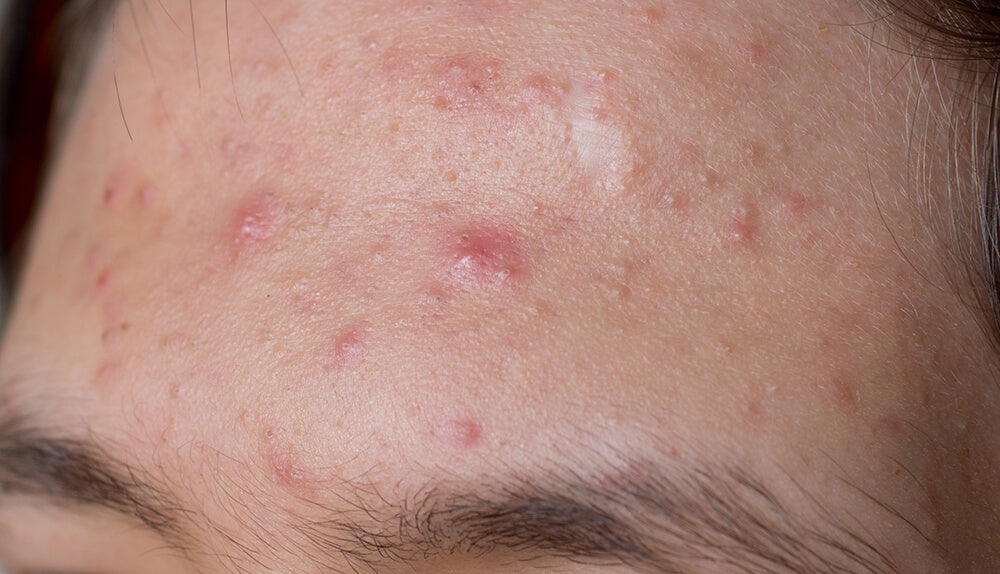 Acne vulgaris on a man's forehead