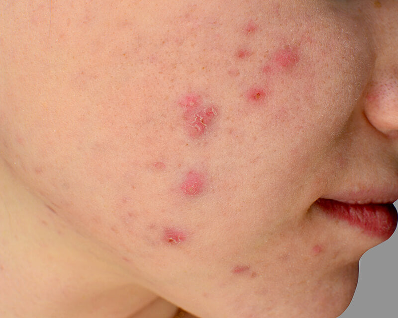 What Is Cystic Acne — And How Do You Treat It Slmd Skincare By