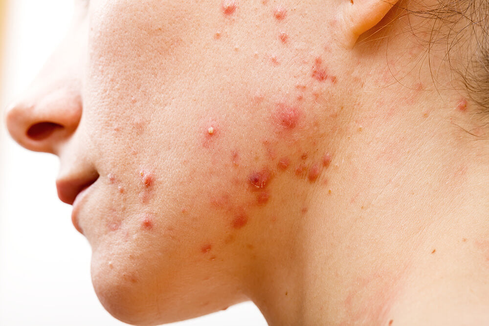 What nodular acne looks like