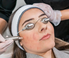 Acne laser treatment being performed