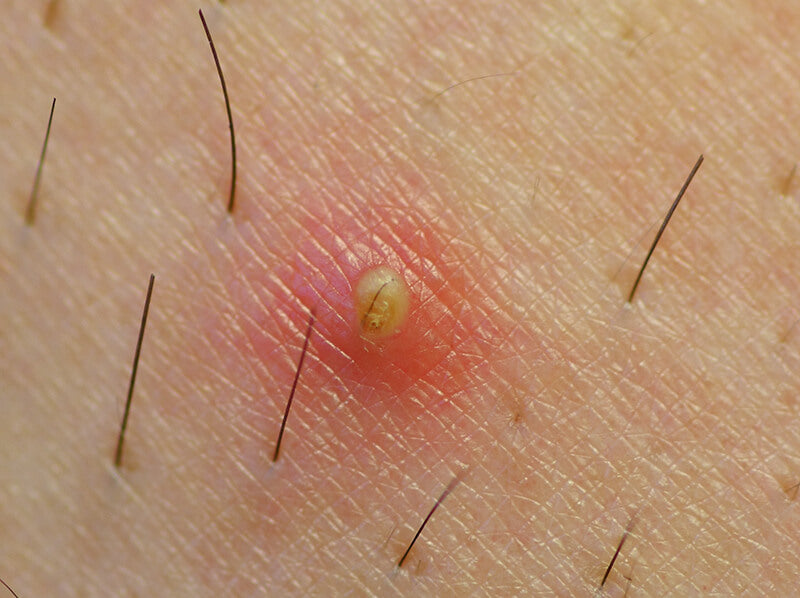How To Treat & Prevent Ingrown Hairs – SLMD Skincare by Sandra Lee, M.D. -  Dr. Pimple Popper