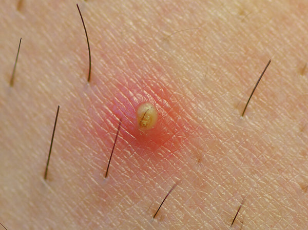 An ingrown hair that can be treated according to Dr. Pimple Popper