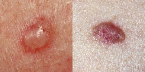 An example of basal cell carcinoma skin cancer