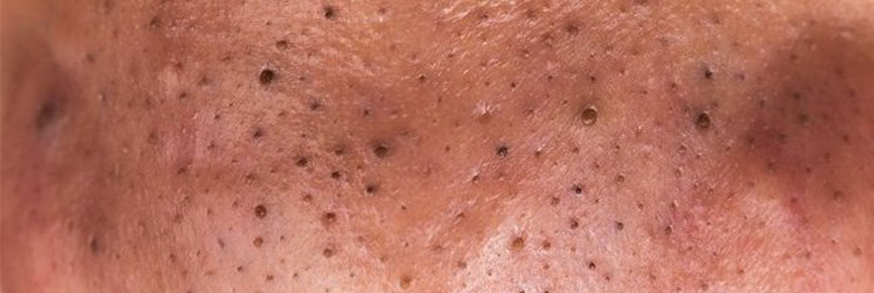 a closeup of acne blackheads