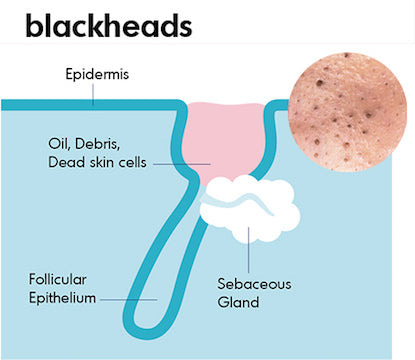 graphic illustration of a blackhead