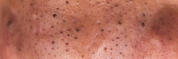 A nose covered in blackheads that are not sebaceous filaments
