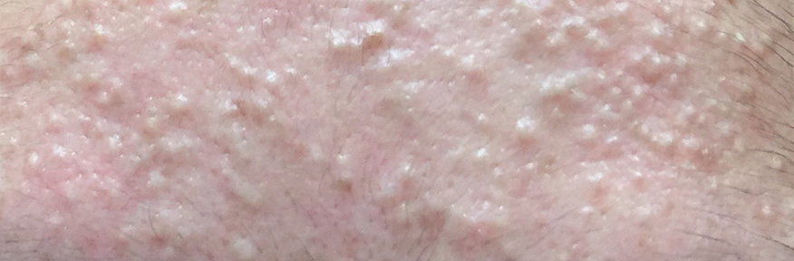 a closeup of acne whiteheads