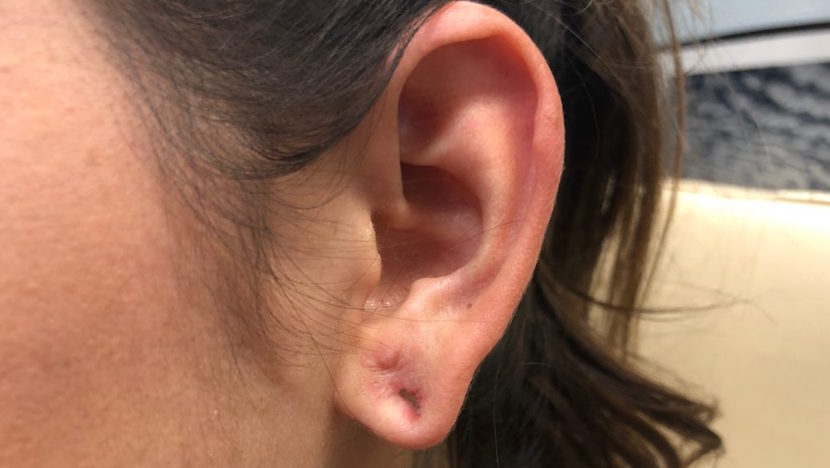 Infected Ear Piercing: Symptoms, Treatment & Prevention