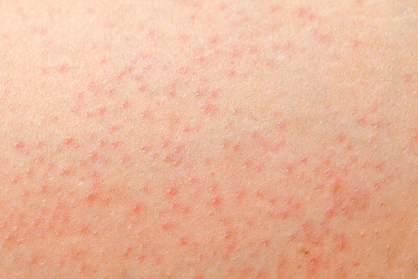 Folliculitis aka fungal acne that cannot be treated with benzoyl peroxide