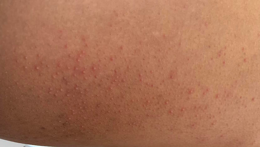 Razor bumps that can be treated with glycolic acid
