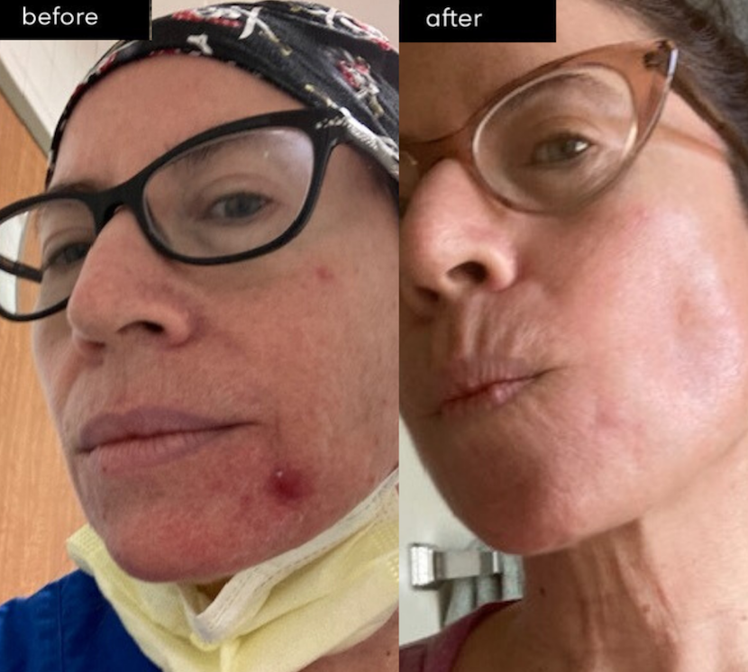 Maskne before and after photo using SLMD Acne System