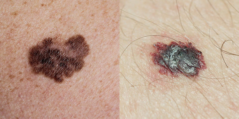 An example of melanoma skin cancer