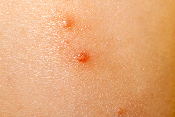 A closeup photo of molluscum contagiosum