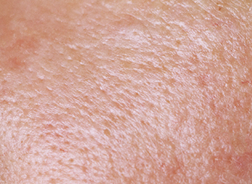 A closeup photo of oily skin