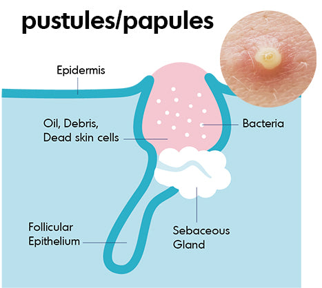 A graphic illustration of an inflammatory pustule