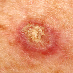 An example of squamous cell carcinoma skin cancer