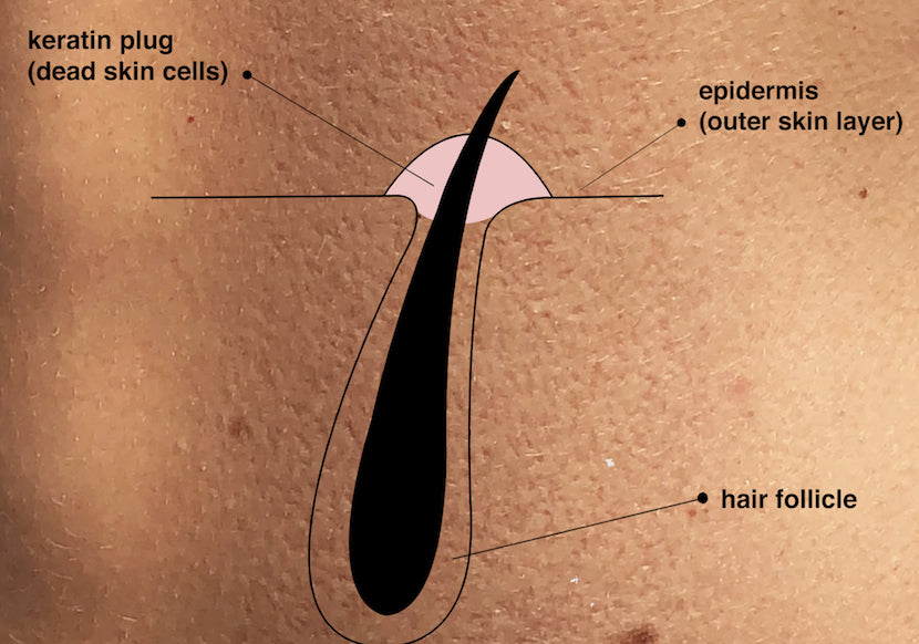 A graphic illustration of what a keratin clogged pore looks like aka keratosis pilaris