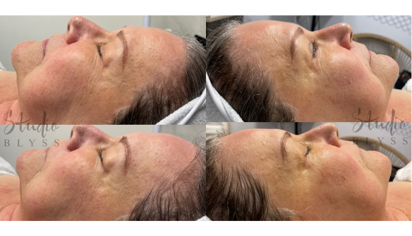 Rezenerate and Myolift Microcurrent Facial Results