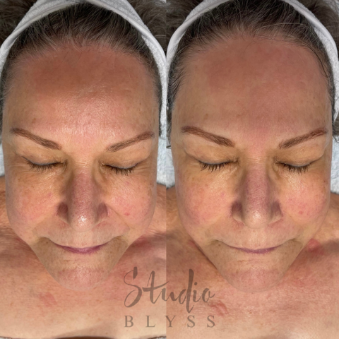 Rezenerate and Myolift Microcurrent Facial Results