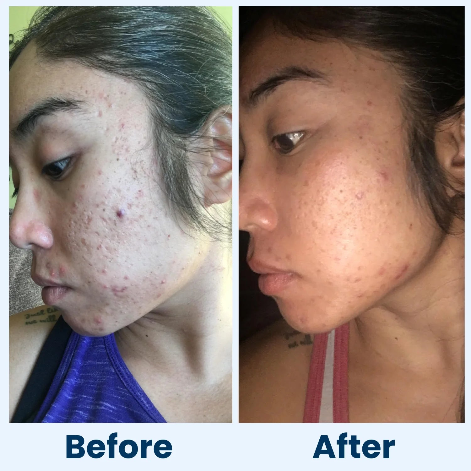 Side-by-side comparison of a person's skin before and after acne treatment.