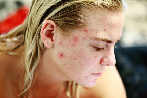 acne sensitive skin