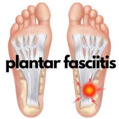 Graphic image of an inflamed plantar fasciitis