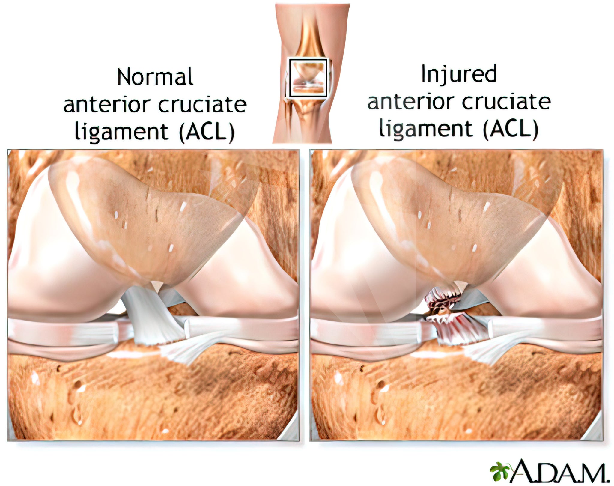Normal anterior cruciate ligament (ACL) vs injured anterior cruciate ligament (a common football injury)