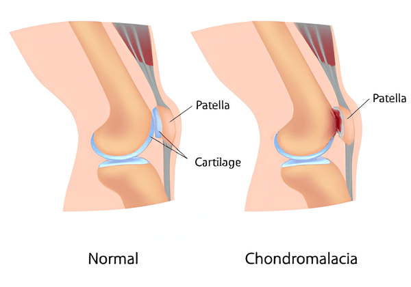 Chondromalacia Patella (CMP)