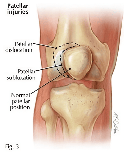 Kneecap subluxation