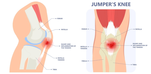 Patellar tendonitis (tendinopathy)