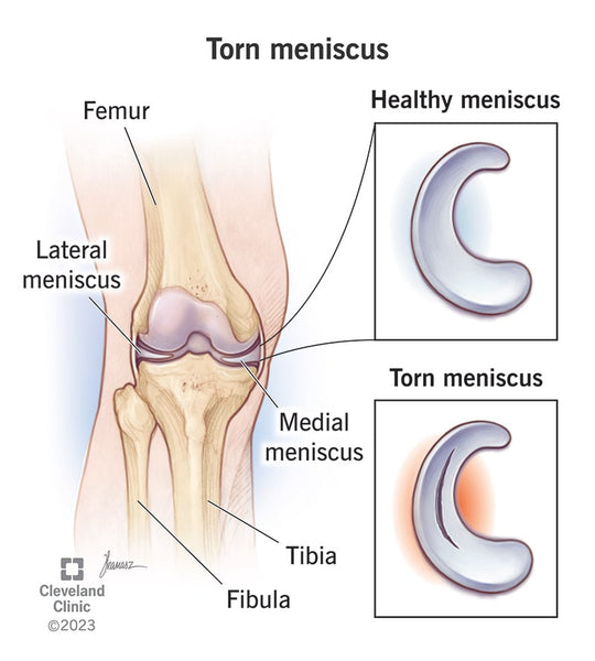 Medial meniscus tear