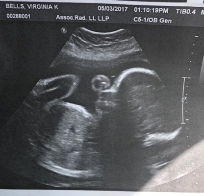 29 hafta ultrason