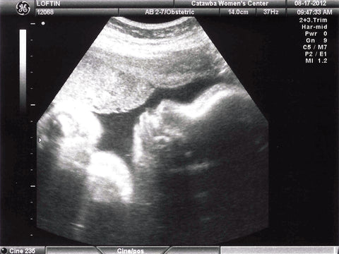 37 haftalık bebek ultrason