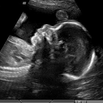 gebelikte 25. hafta ultrason