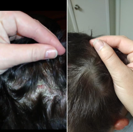 Scalp Psoriasis