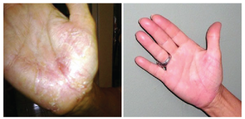Dermasolve Hands Before and After