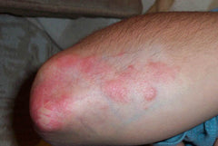 Dermasolve Psoriasis Elbows