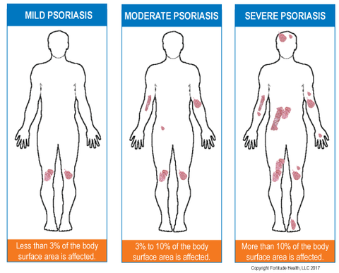 Severity of Psoriasis Dermasolve