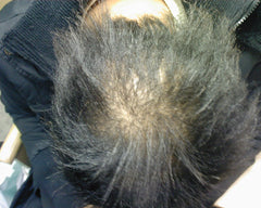 Black Hair Loss