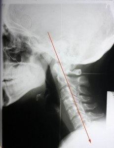 What Military neck looks like on an x-ray