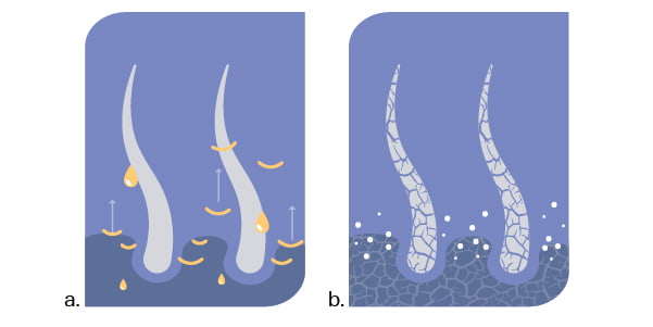 Dandruff vs Dry Scalp