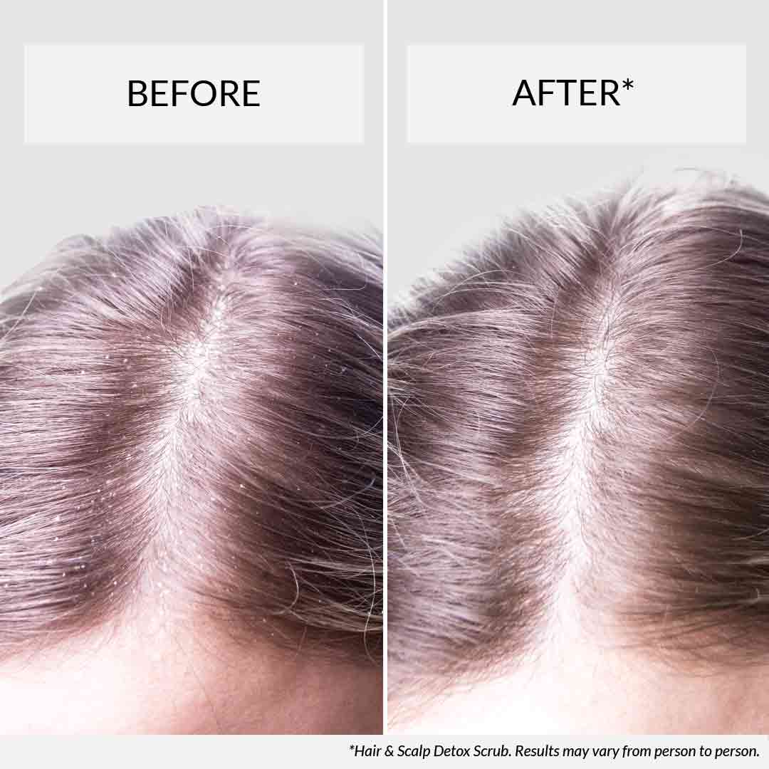 dry scalp before and after