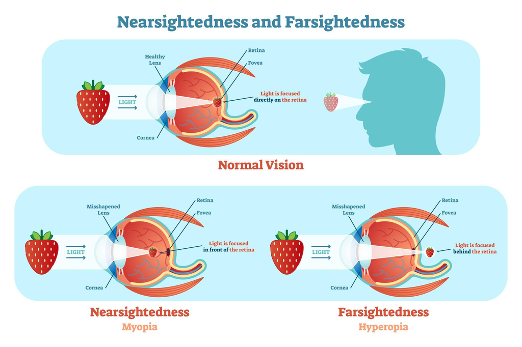 Myopia vs. Hyperopia